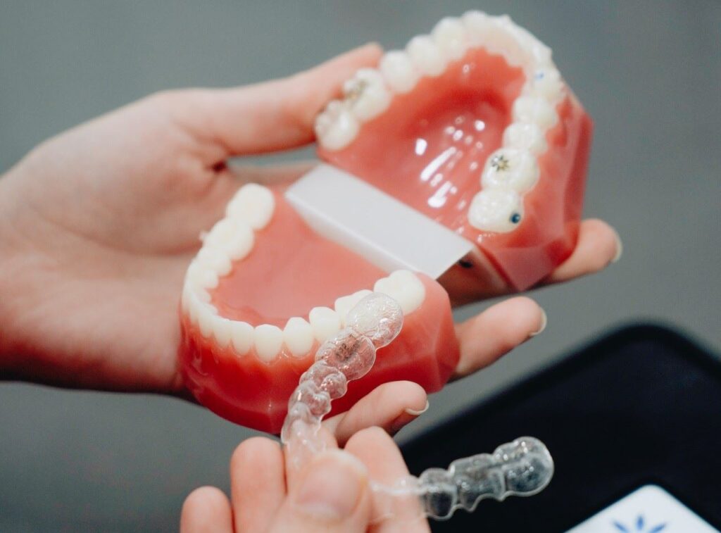 Clear Aligners